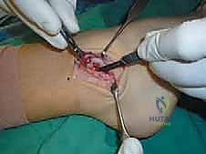 تنظيف المفصل من الأنسجة الملتهبة