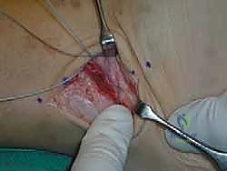 تثبيت الخطاف في العظم