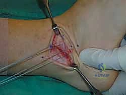 صورة توضيحية لـ إتقان إصلاح أربطة الكاحل الجانبية: دليل شامل لعملية بروسترم المعدلة مع الأستاذ الدكتور محمد هطيف