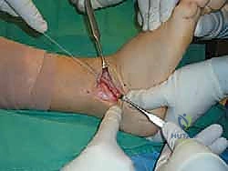 شد الأربطة لدرجة الثبات المطلوبة