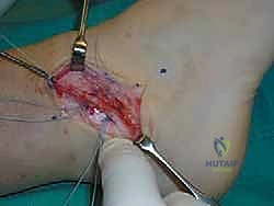 صورة توضيحية لـ إتقان إصلاح أربطة الكاحل الجانبية: دليل شامل لعملية بروسترم المعدلة مع الأستاذ الدكتور محمد هطيف