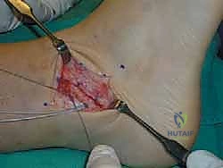 صورة توضيحية لـ إتقان إصلاح أربطة الكاحل الجانبية: دليل شامل لعملية بروسترم المعدلة مع الأستاذ الدكتور محمد هطيف