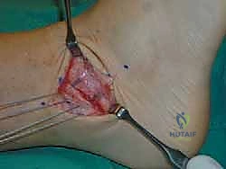 صورة طبية: إتقان إصلاح أربطة الكاحل الجانبية: دليل شامل لعملية بروسترم المعدلة مع الأستاذ الدكتور محمد هطيف