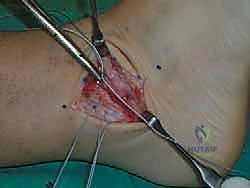 صورة توضيحية لـ إتقان إصلاح أربطة الكاحل الجانبية: دليل شامل لعملية بروسترم المعدلة مع الأستاذ الدكتور محمد هطيف