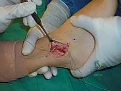 اختبار الدرج الأمامي السريري