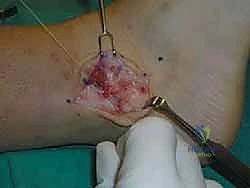 صورة طبية: إتقان إصلاح أربطة الكاحل الجانبية: دليل شامل لعملية بروسترم المعدلة مع الأستاذ الدكتور محمد هطيف