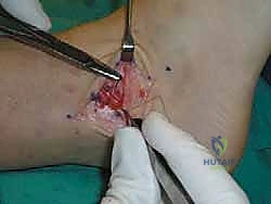 زرع الخطاف الثاني إذا لزم الأمر