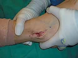 تجهيز الخيوط الجراحية القوية