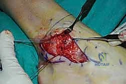 دقة جراحية عالية في التعامل مع الأنسجة