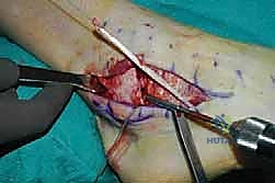 صورة طبية: إتقان إصلاح أربطة الكاحل الجانبية: دليل شامل لعملية بروسترم المعدلة مع الأستاذ الدكتور محمد هطيف