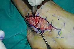 صورة توضيحية لـ إتقان إصلاح أربطة الكاحل الجانبية: دليل شامل لعملية بروسترم المعدلة مع الأستاذ الدكتور محمد هطيف