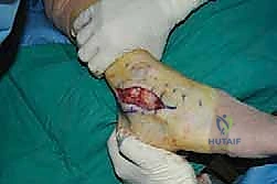 صورة طبية: إتقان إصلاح أربطة الكاحل الجانبية: دليل شامل لعملية بروسترم المعدلة مع الأستاذ الدكتور محمد هطيف