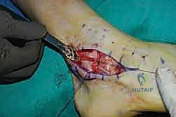 فحص مجال الحركة للكاحل