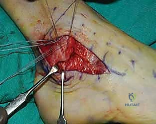 صورة رنين مغناطيسي توضح التمزق