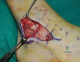 صورة توضيحية لـ إتقان إصلاح أربطة الكاحل الجانبية: دليل شامل لعملية بروسترم المعدلة مع الأستاذ الدكتور محمد هطيف