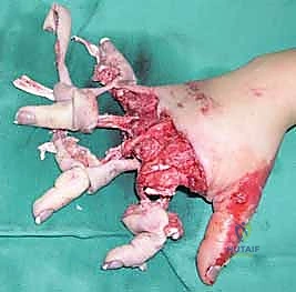 آليات إصابة وبتر الأصابع