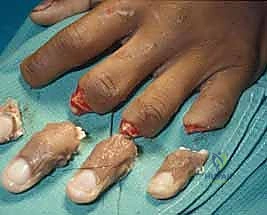 تشريح الأوعية الدموية الدقيقة في اليد