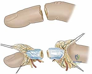صورة طبية: إعادة زرع الأصابع وإعادة توصيل الأوعية الدموية: دليل شامل للمرضى مع الأستاذ الدكتور محمد هطيف