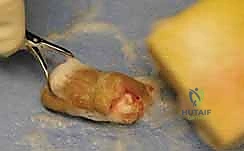 صورة توضيحية لـ إعادة زرع الأصابع وإعادة توصيل الأوعية الدموية