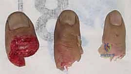 إعادة زرع الأصابع وإعادة توصيل الأوعية الدموية: دليل شامل للمرضى مع الأستاذ الدكتور محمد هطيف