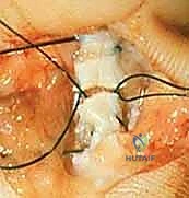 صورة توضيحية لـ إعادة زرع الأصابع وإعادة توصيل الأوعية الدموية: دليل شامل للمرضى مع الأستاذ الدكتور محمد هطيف