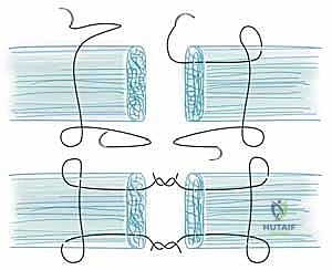 صورة توضيحية لـ إعادة زرع الأصابع وإعادة توصيل الأوعية الدموية: دليل شامل للمرضى مع الأستاذ الدكتور محمد هطيف