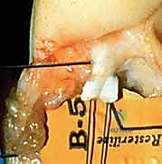 صورة طبية: إعادة زرع الأصابع وإعادة توصيل الأوعية الدموية: دليل شامل للمرضى مع الأستاذ الدكتور محمد هطيف