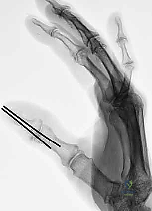 صورة طبية: إعادة زرع الأصابع وإعادة توصيل الأوعية الدموية: دليل شامل للمرضى مع الأستاذ الدكتور محمد هطيف