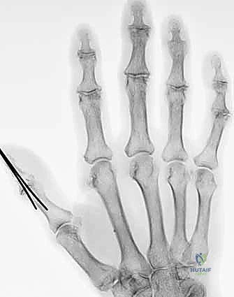 صورة طبية: إعادة زرع الأصابع وإعادة توصيل الأوعية الدموية: دليل شامل للمرضى مع الأستاذ الدكتور محمد هطيف