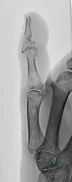 صورة طبية: إعادة زرع الأصابع وإعادة توصيل الأوعية الدموية: دليل شامل للمرضى مع الأستاذ الدكتور محمد هطيف