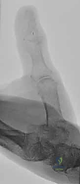 صورة طبية: إعادة زرع الأصابع وإعادة توصيل الأوعية الدموية: دليل شامل للمرضى مع الأستاذ الدكتور محمد هطيف