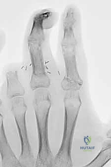 صورة طبية: إعادة زرع الأصابع وإعادة توصيل الأوعية الدموية: دليل شامل للمرضى مع الأستاذ الدكتور محمد هطيف