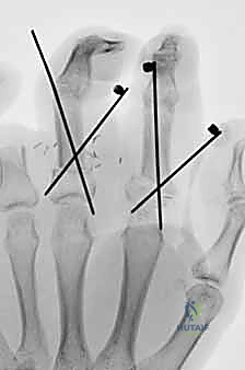 صورة طبية: إعادة زرع الأصابع وإعادة توصيل الأوعية الدموية: دليل شامل للمرضى مع الأستاذ الدكتور محمد هطيف