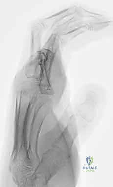 Intraoperative Surgical Step