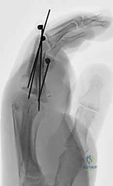 صورة طبية: إعادة زرع الأصابع وإعادة توصيل الأوعية الدموية: دليل شامل للمرضى مع الأستاذ الدكتور محمد هطيف