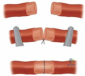 صورة طبية: إعادة زرع الأصابع وإعادة توصيل الأوعية الدموية: دليل شامل للمرضى مع الأستاذ الدكتور محمد هطيف