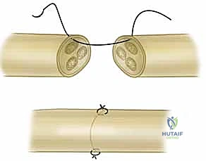 صورة توضيحية لـ إعادة زرع الأصابع وإعادة توصيل الأوعية الدموية: دليل شامل للمرضى مع الأستاذ الدكتور محمد هطيف