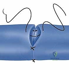 صورة توضيحية لـ إعادة زرع الأصابع وإعادة توصيل الأوعية الدموية: دليل شامل للمرضى مع الأستاذ الدكتور محمد هطيف