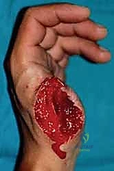 صورة توضيحية لـ إعادة زرع الأصابع وإعادة توصيل الأوعية الدموية: دليل شامل للمرضى مع الأستاذ الدكتور محمد هطيف