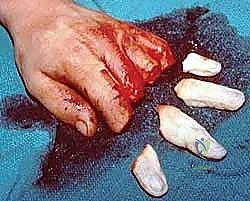 صورة طبية: إعادة زرع الأصابع وإعادة توصيل الأوعية الدموية: دليل شامل للمرضى مع الأستاذ الدكتور محمد هطيف