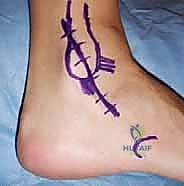 صورة توضيحية لـ إعادة بناء أربطة الكاحل الجانبية: تقنية بروسترم غولد المعدلة لعلاج عدم الاستقرار المزمن مع الأستاذ الدكتور محمد هطيف