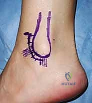 صورة توضيحية لـ إعادة بناء أربطة الكاحل الجانبية: تقنية بروسترم غولد المعدلة لعلاج عدم الاستقرار المزمن مع الأستاذ الدكتور محمد هطيف