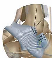 الفحص السريري لعدم استقرار الكاحل المزمن