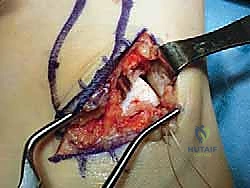 صورة طبية: إعادة بناء أربطة الكاحل الجانبية: تقنية بروسترم غولد المعدلة لعلاج عدم الاستقرار المزمن مع الأستاذ الدكتور محمد هطيف