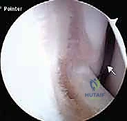 صورة توضيحية لـ إعادة بناء أربطة الكاحل الجانبية: تقنية بروسترم غولد المعدلة لعلاج عدم الاستقرار المزمن مع الأستاذ الدكتور محمد هطيف