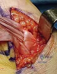 Illustration of repair of lateral - Dr. Mohammed Hutaif