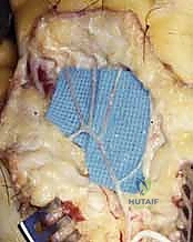 صورة توضيحية لـ إعادة توعية اليد: دليل شامل لعلاج متلازمة رينود والانسدادات الوعائية في صنعاء مع الأستاذ الدكتور محمد هطيف
