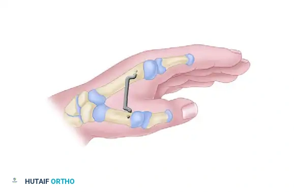 Abductor Digiti Quinti Opponensplasty & Thumb Reconstruction