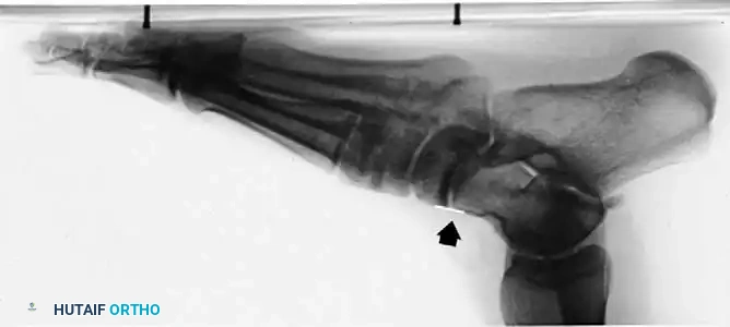 ACCESSORY NAVICULAR Surgical Diagram