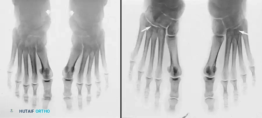ACCESSORY NAVICULAR Surgical Diagram